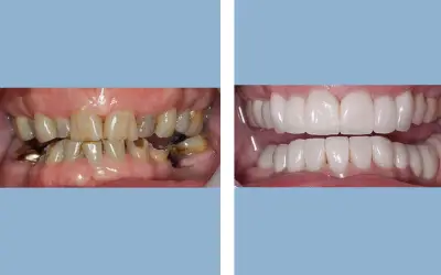 Before and After